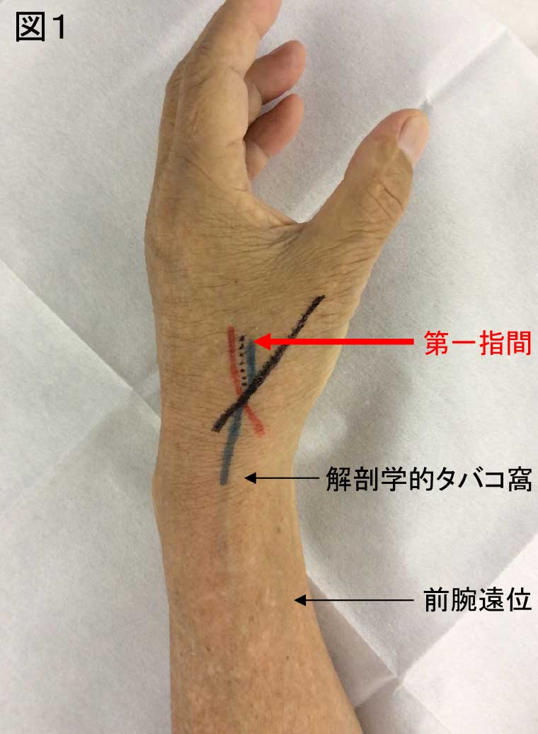 タ バチ エール シャント と は